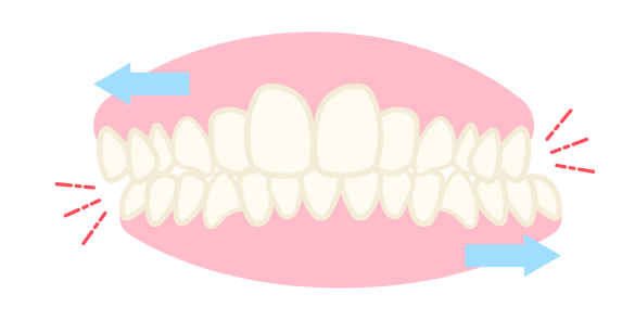 Bruxism