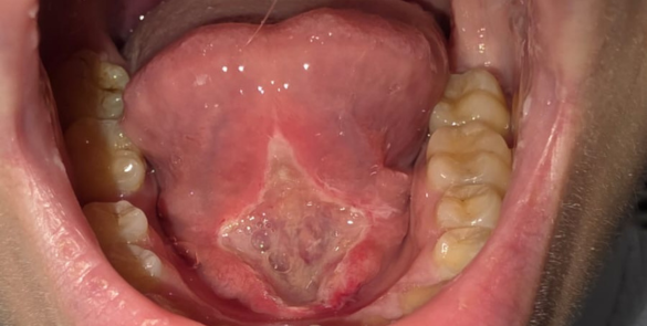 frenectomie laser