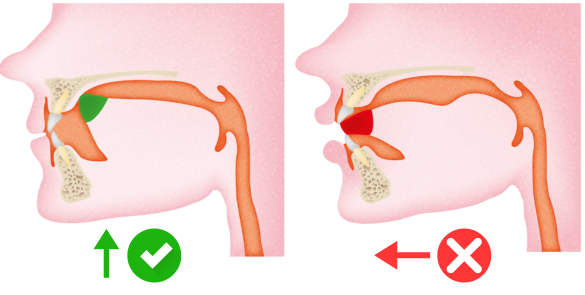 Deglutitie atipica