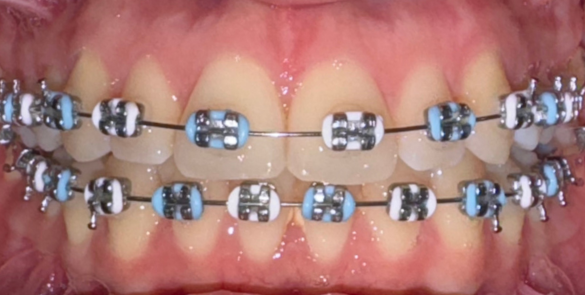 Aparat Dentar