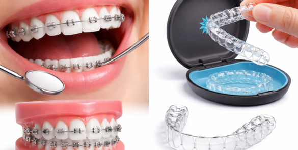 Aparat Dentar