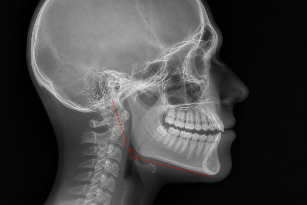 Tipar facial Hipodivergent