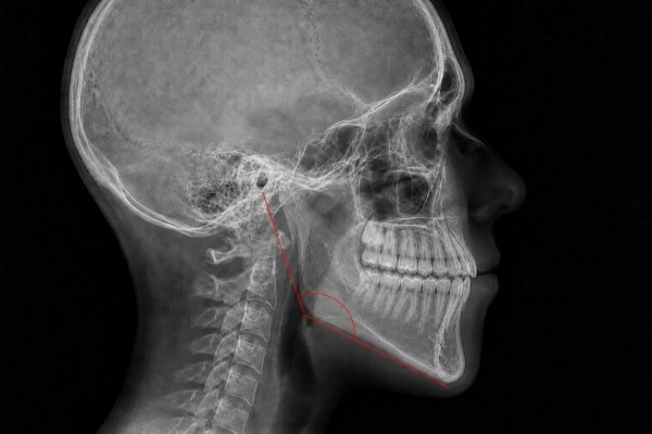Profil facial cu tipar de creștere hipodivergent, ilustrare pentru articol ortodontic.
